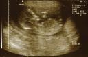 New Baby 14 Wk Scan Pic